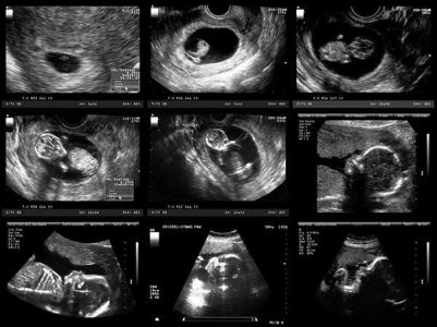 بررسی اندازه bpd در سونوگرافی جنین در هفته های مختلف
