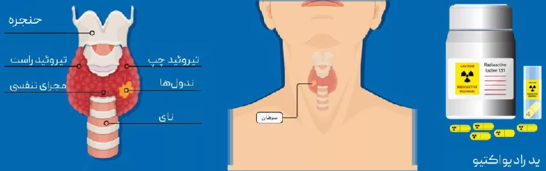 ید درمانی با ید 131 در بیماران مبتلا به سرطان تیروئید