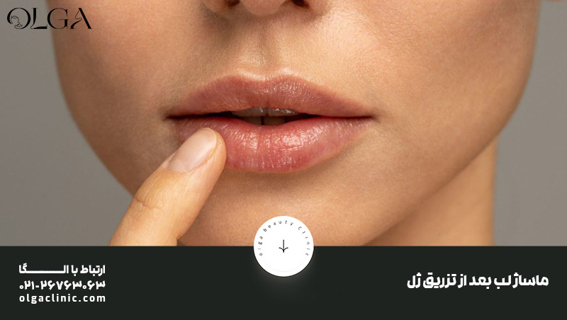 ماساژ بعد از تزریق ژل لب